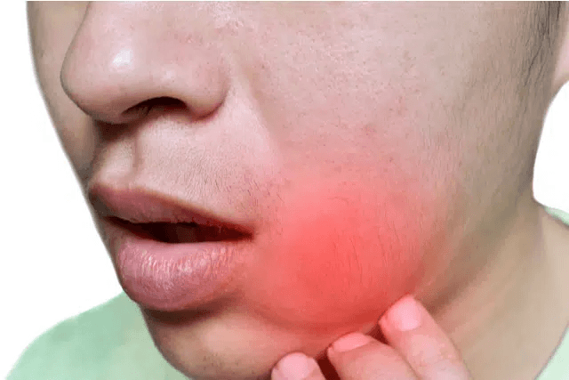 Facial swelling dental infection emergency same day treatment WD6